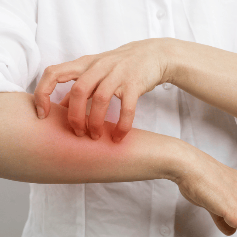 Allergy Management